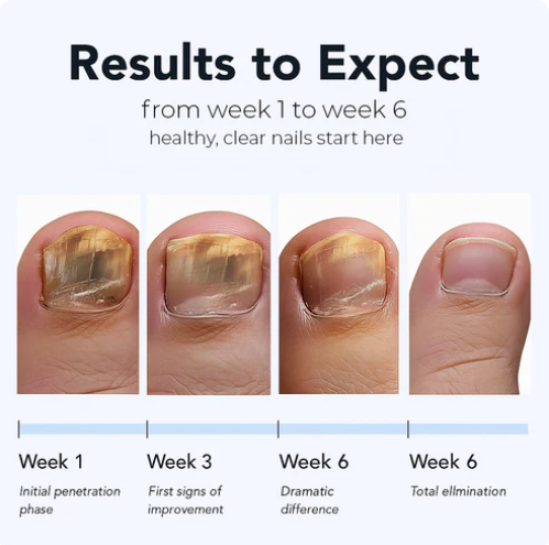 ClearTip™ - Fungal Nail Patches