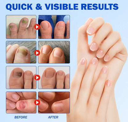 ClearTip™ - Fungal Nail Patches